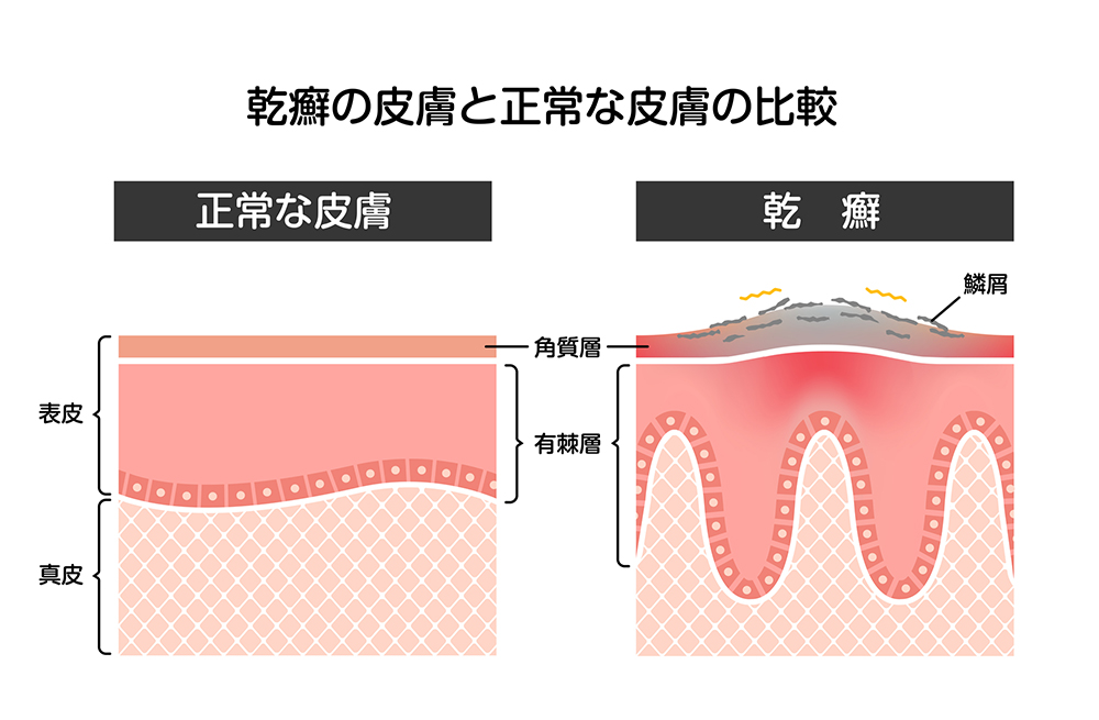 乾癬（かんせん）とは