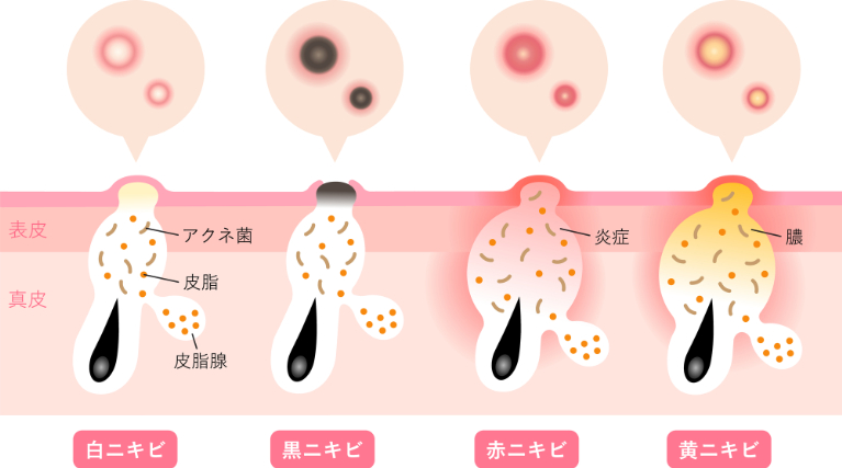 ニキビの種類